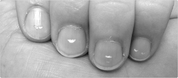 White Spots On Your Nails Think Zinc Deficiency HealthPost NZ